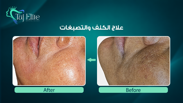 before-^-after12